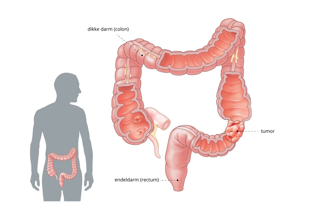 coloncarcinoom
