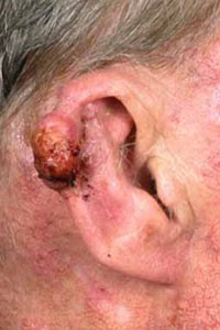 Plaveiselcelcarcinoom