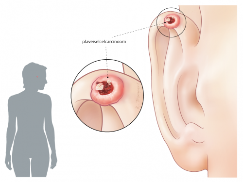 Plaveiselcelcarcinoom